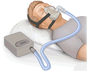 CPAP